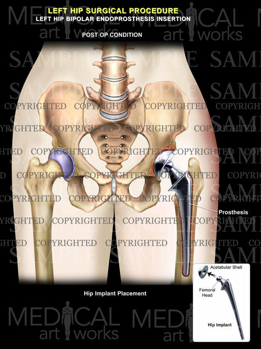 Left total hip surgical procedure