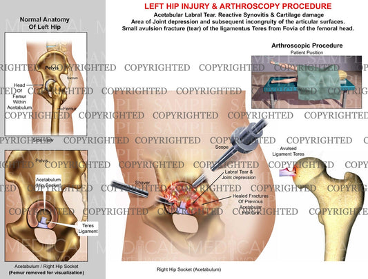 Left hip labral tear and reactive synovitis