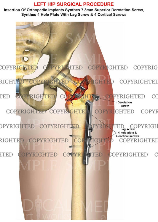 Hip plate and screw fixation, left