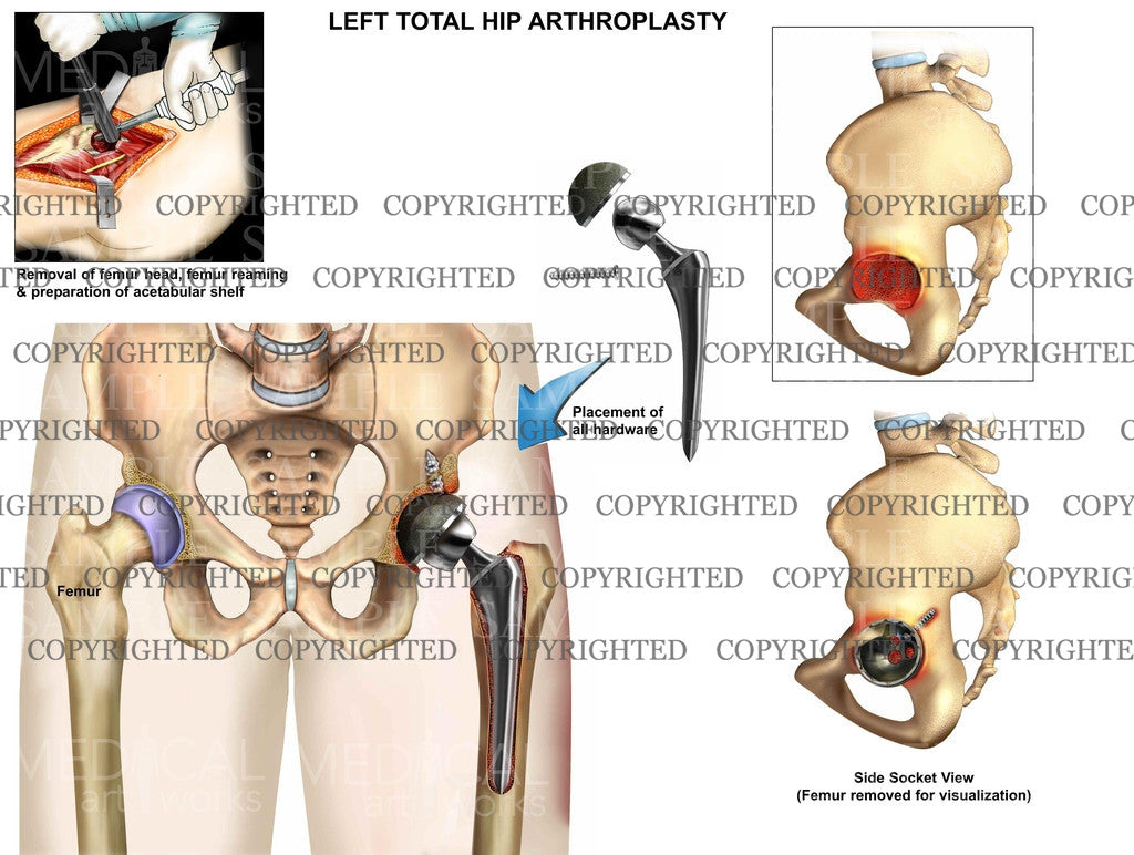 Left hip hemiarthroplasty