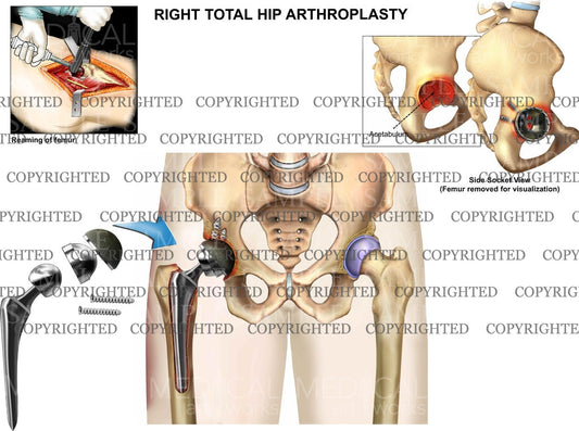 Right total hip arthroplasty