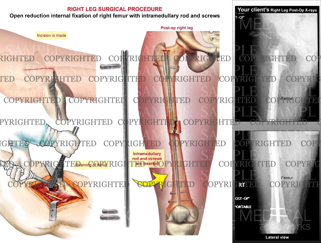 Right femur intramedullary rod fixation