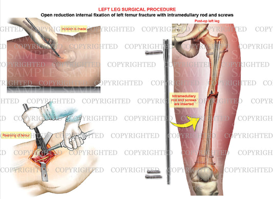 Open reduction internal fixation of left femur displaced femoral shaft fracture