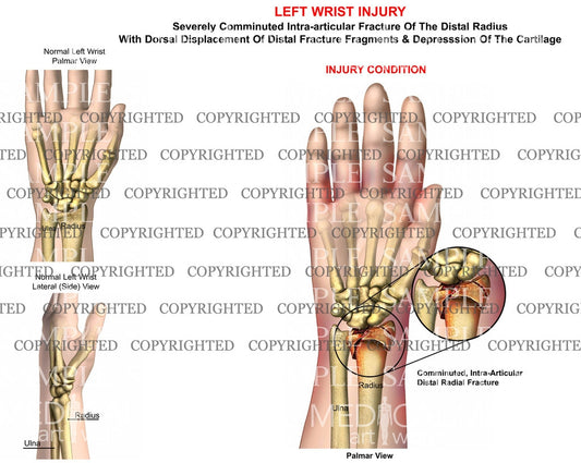 Left radius comminuted displaced fracture