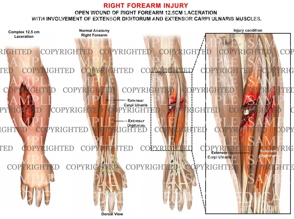 Right forearm injury condition 2