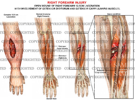 Right forearm injury condition 2