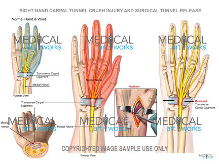 Right wrist carpal tunnel and surgical release