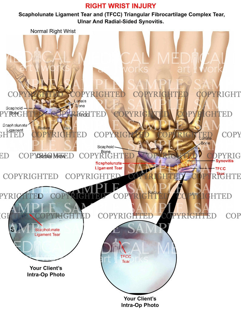 Right wrist TFCC & ligament tear