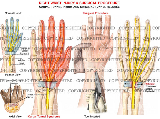 Carpal tunnel injury and surgical Tunnel release