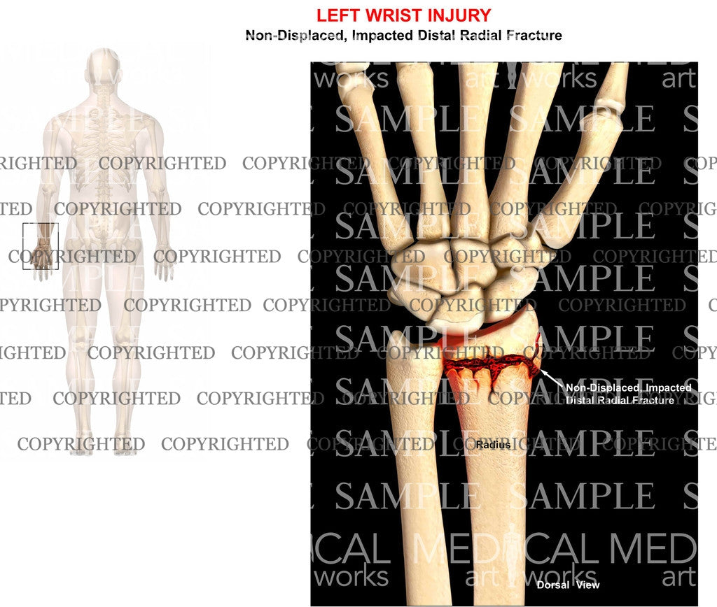 Left distal radial fracture