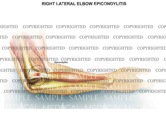 Right elbow epicondylitis