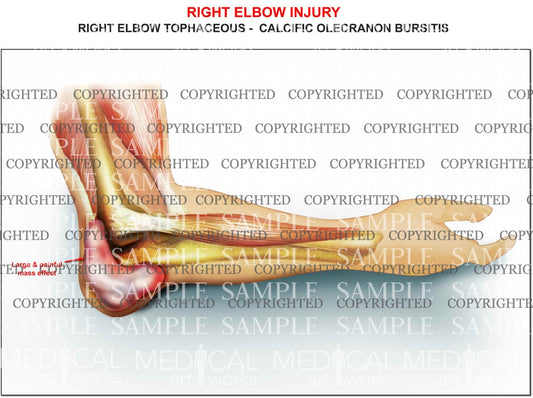 Right elbow olecranon bursitis