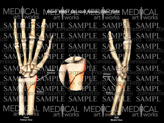 Right radial oblique fracture