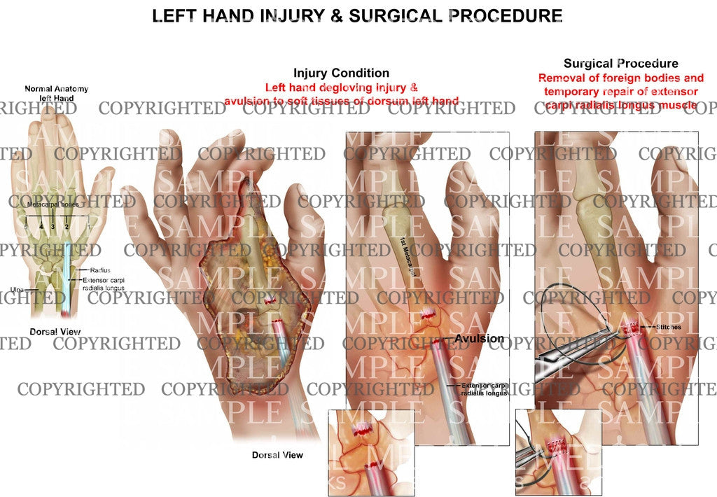 Left hand degloving injury