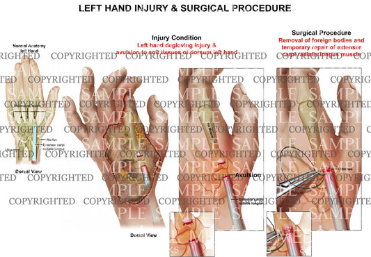 Left hand degloving injury