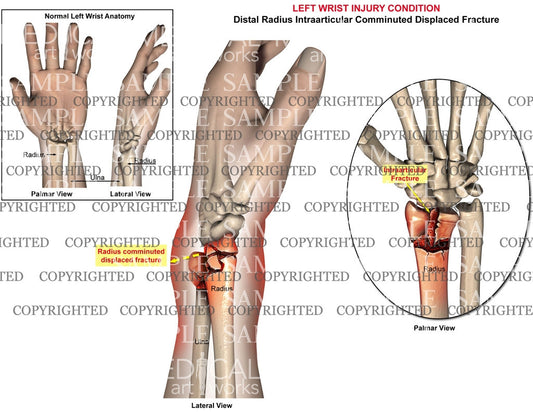 Left intraarticular radial fracture
