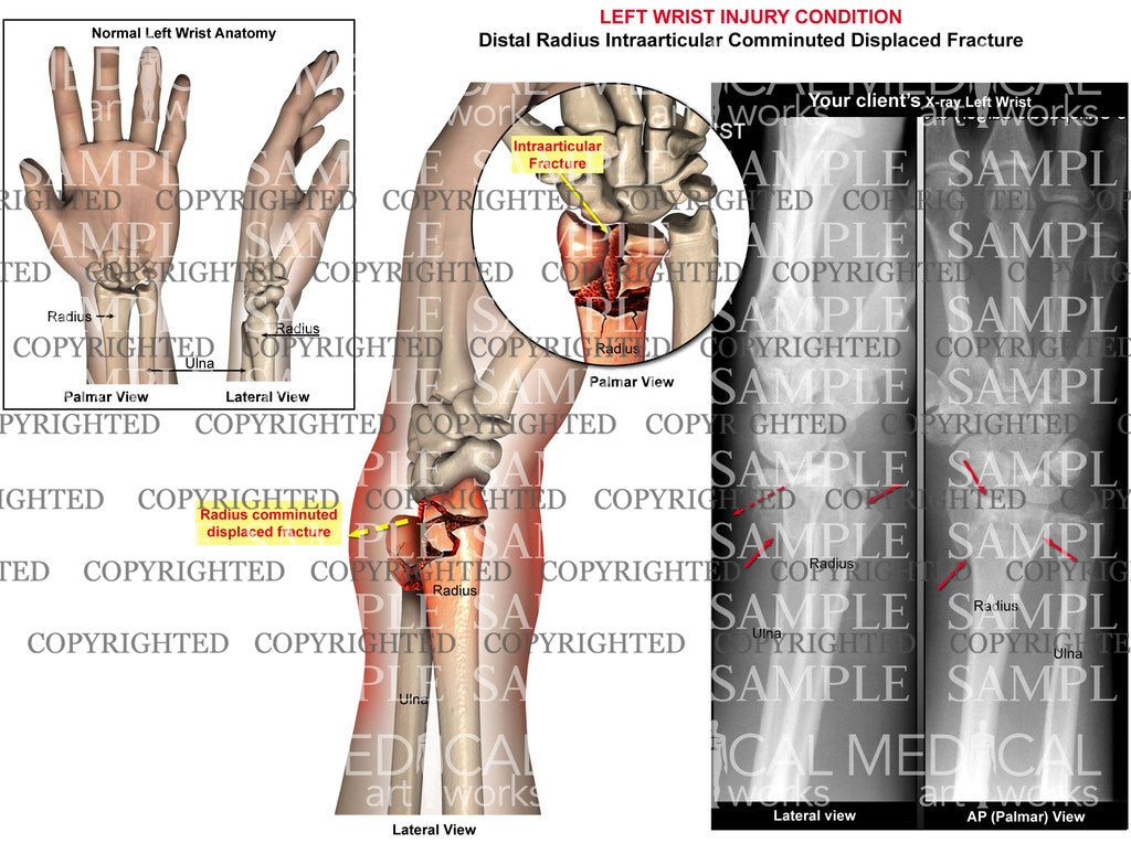 Left radial intraarticular fracture2