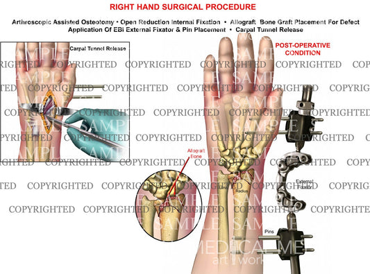 Right wrist osteotomy, graft, pin, EBI, ORIF