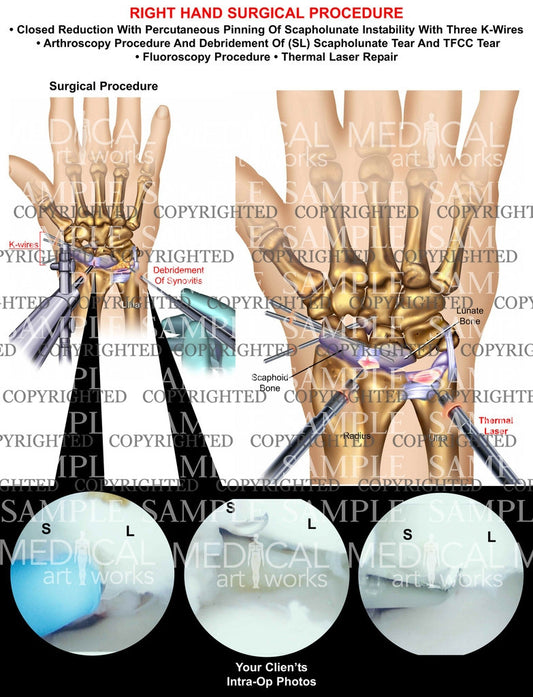 Right hand scapholunate pinning