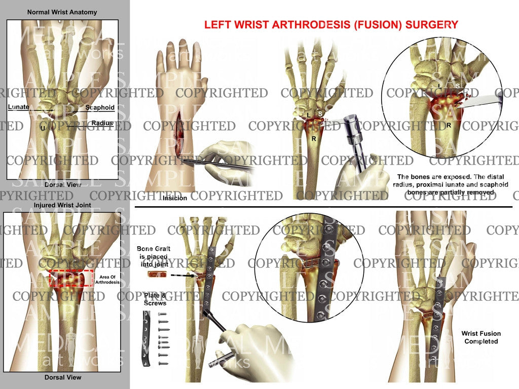 Left wrist arthrodesis surgery