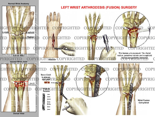 Left wrist arthrodesis surgery