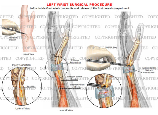 Left wrist surgical procedure of  de Quervain's tendonitis & release of dorsal compartment