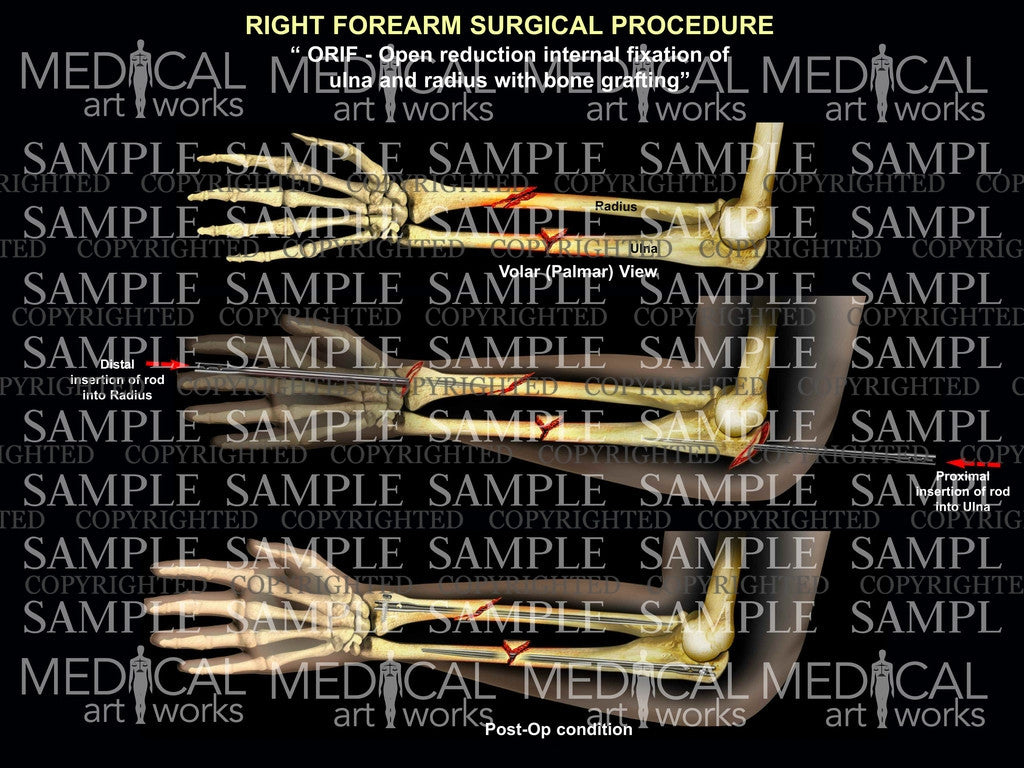 Right forearm radial ulna rodding