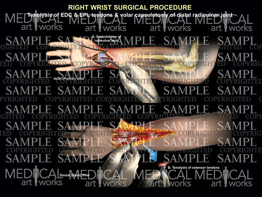 Right wrist tenolysis, capsulotomy