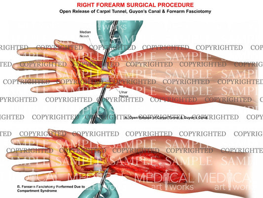 Forearm compartment syndrome fasciotomy