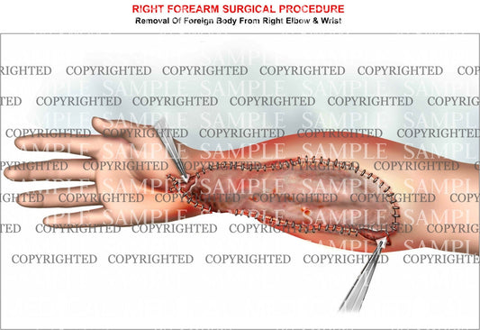 Forearm grafting procedure
