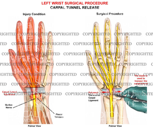 Left carpal tunnel release
