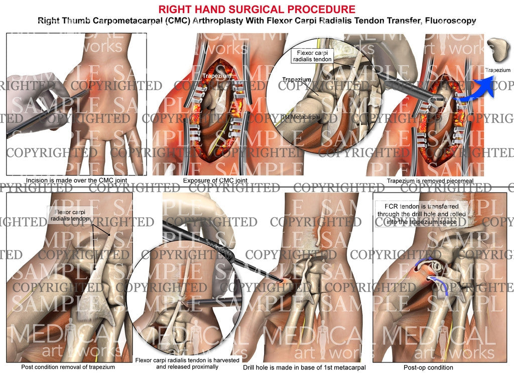 Right hand surgical procedure