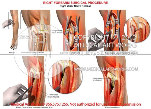 Right ulnar nerve release