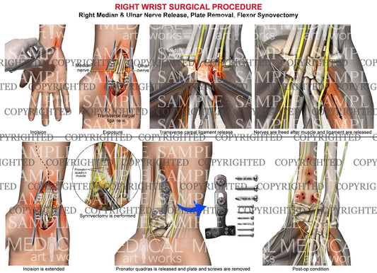 Right ulnar and median nerve release