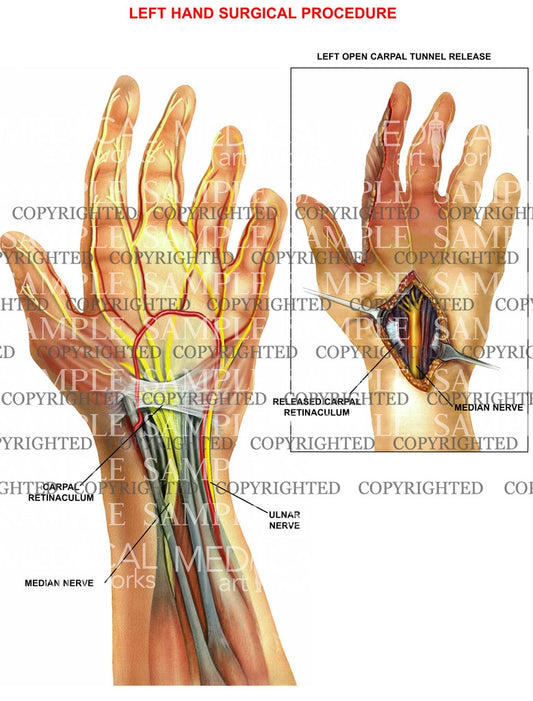 Left hand carpal tunnel procedure