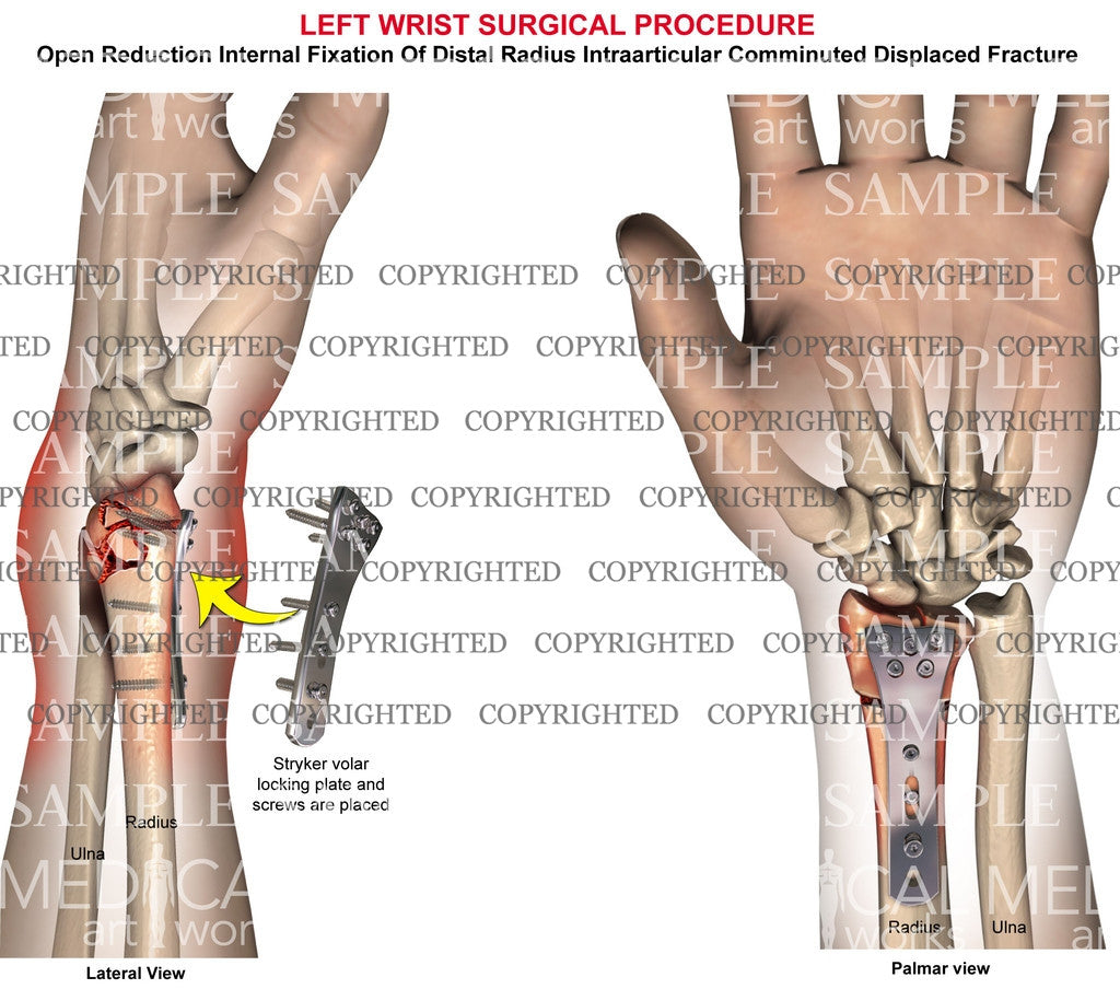 Left radial intraarticular fracture surgery