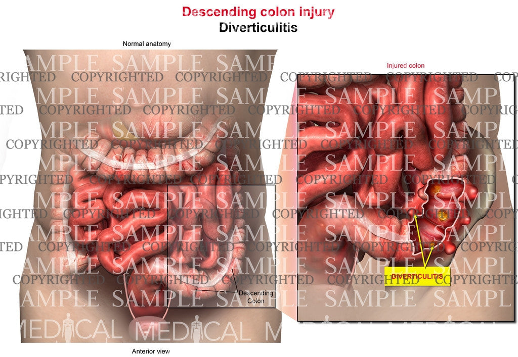 Descending colon injury