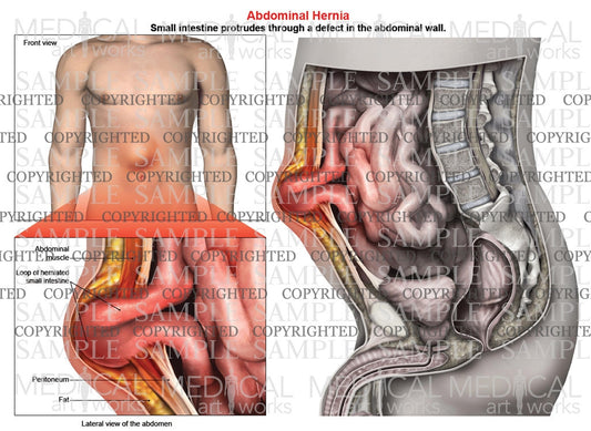 Abdominal hernia anatomy of male