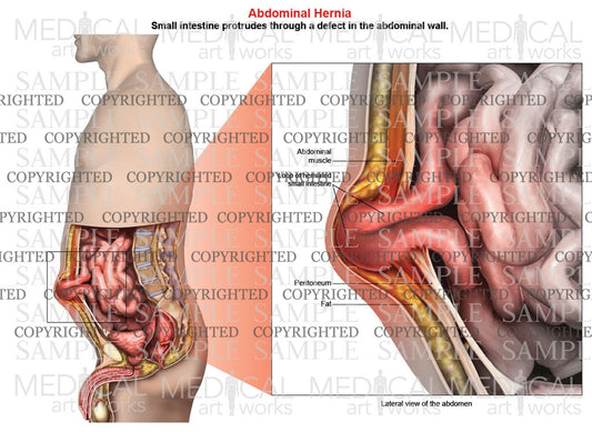 Abdominal hernia anatomy of male, lateral view