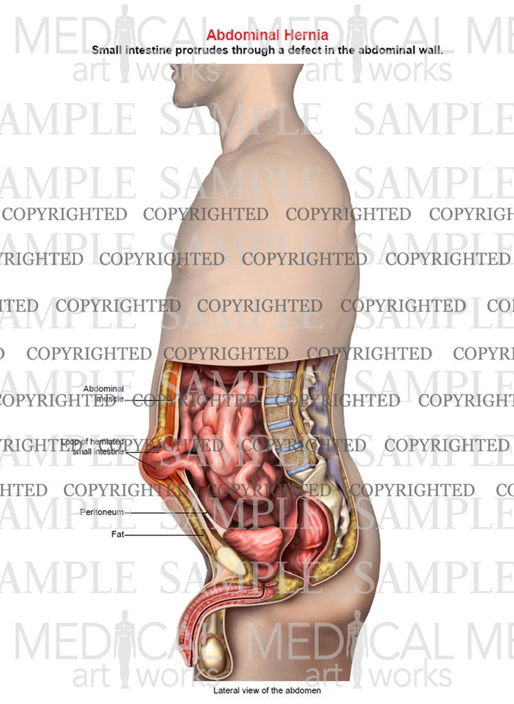 Abdominal hernia anatomy of male, lateral single view