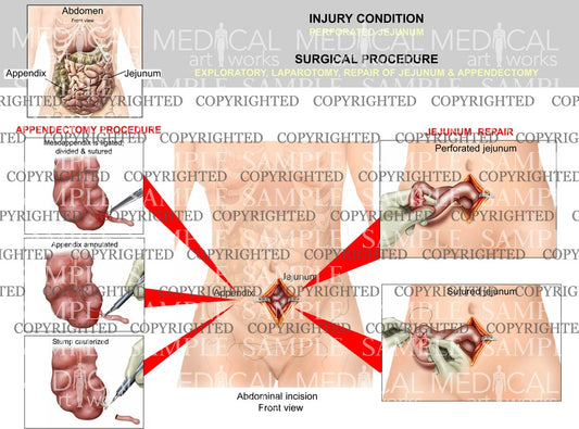 Jejunum injury and surgical repair