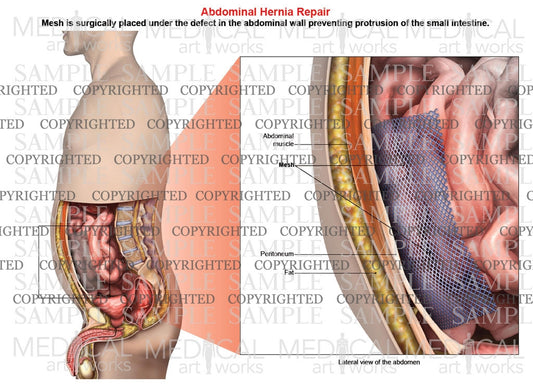 Abdominal hernia mesh repair of a male