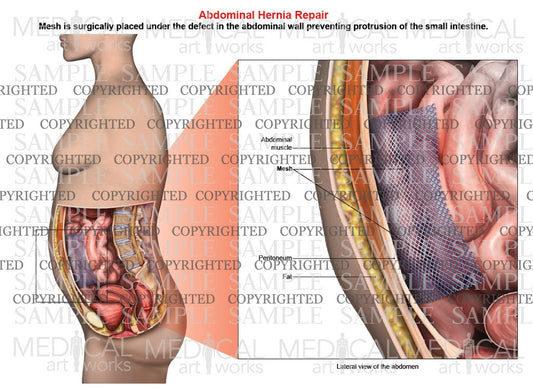 Abdominal hernia mesh repair of a female