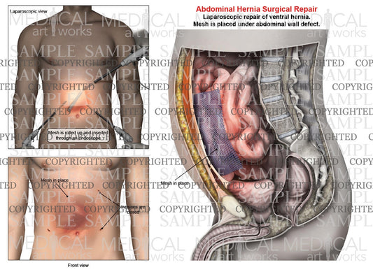 Abdominal ventral hernia mesh repair of a male