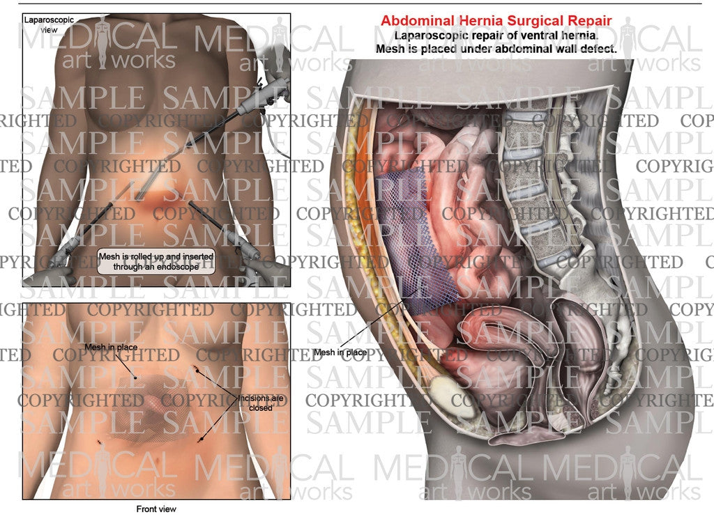 Abdominal ventral hernia mesh repair of a female