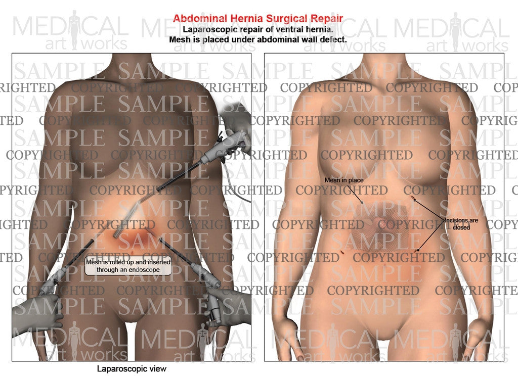 Abdominal ventral hernia mesh repair of a female, front view