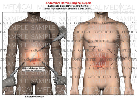 Abdominal ventral hernia mesh repair of a male, front view