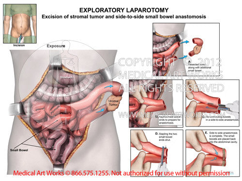 Exploratory Laparotomy - Stromal Tumor