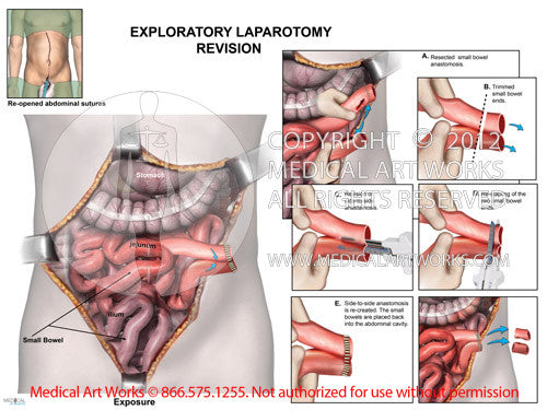 Exploratory Laparotomy - Revision