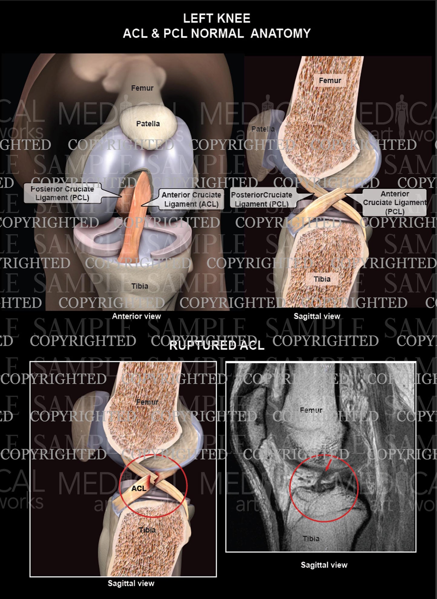 Normal ACL & PCL Left Knee Anatomy - Ruptured ACL - MRI of Ruptured ACL